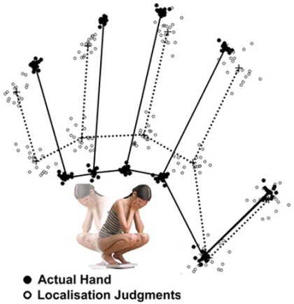 Hand projections demonstrate how anorexia works